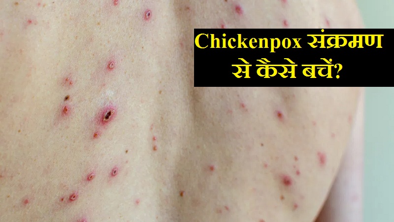 Chickenpox संक्रमण