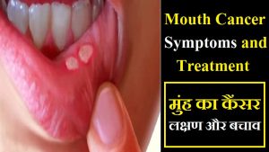 Mouth Cancer Symptoms and Treatment