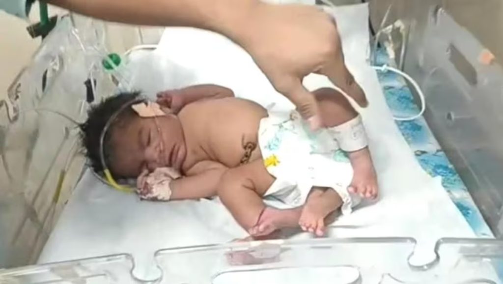 मध्य प्रदेश में महिला ने चार पैरों वाली बच्ची को दिया जन्म, हैरान हुए लोग