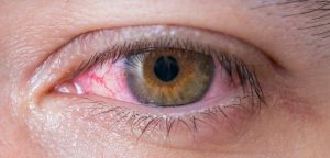 Side Effects of air Pollution in eye