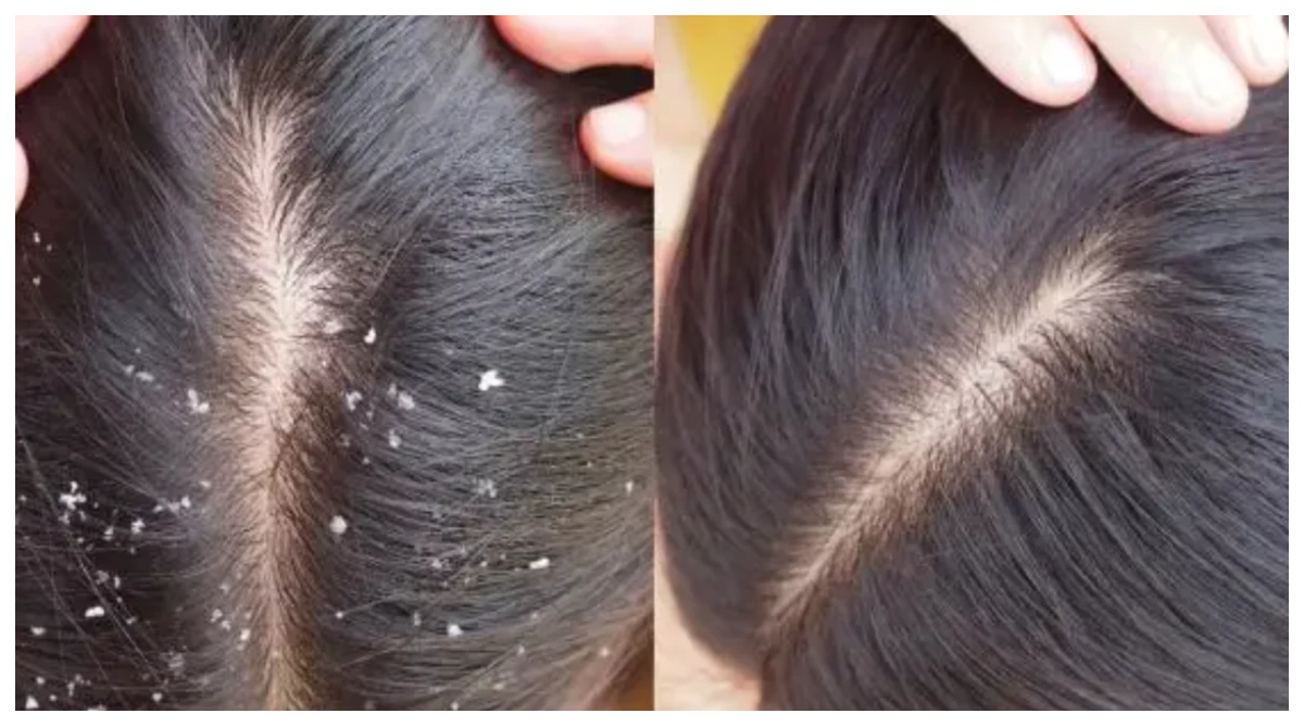 Photo of Dandruff Remedy: डैंड्रफ की छुट्टी कर देगा कपूर का तेल, जानिए कैसे करें इस्तेमाल