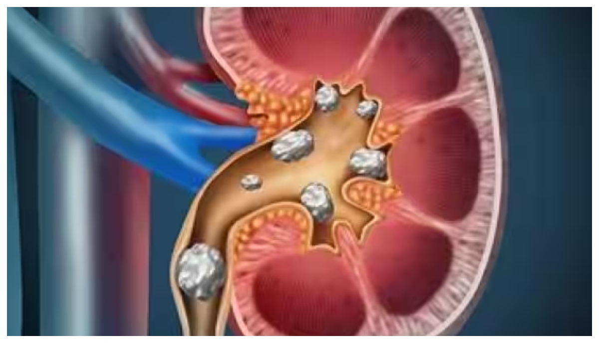 Photo of Kidney Stone: क्यों बनती है गुर्दे की पथरी? किन चीजों से करें परहेज ताकि बीमारी से रहें दूर