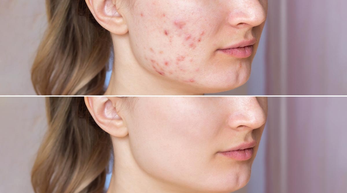 Photo of Skin Problems: चेहरे पर पिंपल, दाग-धब्बों की टेंशन…इस चीज का करें इस्तेमाल…स्किन प्रॉब्लम हो जाएगी छू मंतर
