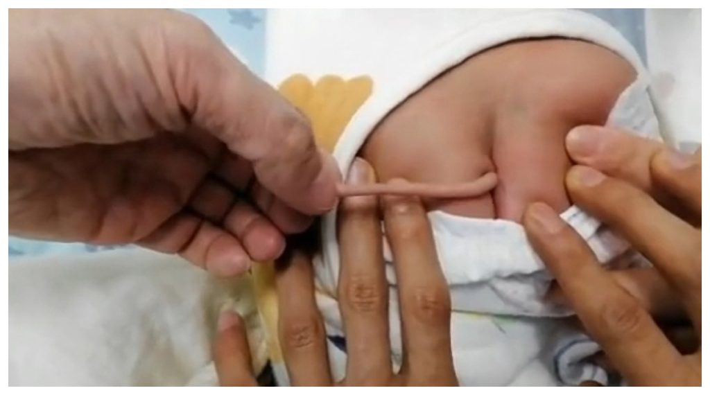 Baby born with 4 inch long tail, doctors confused