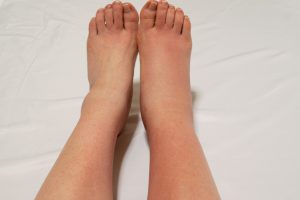 Swelling