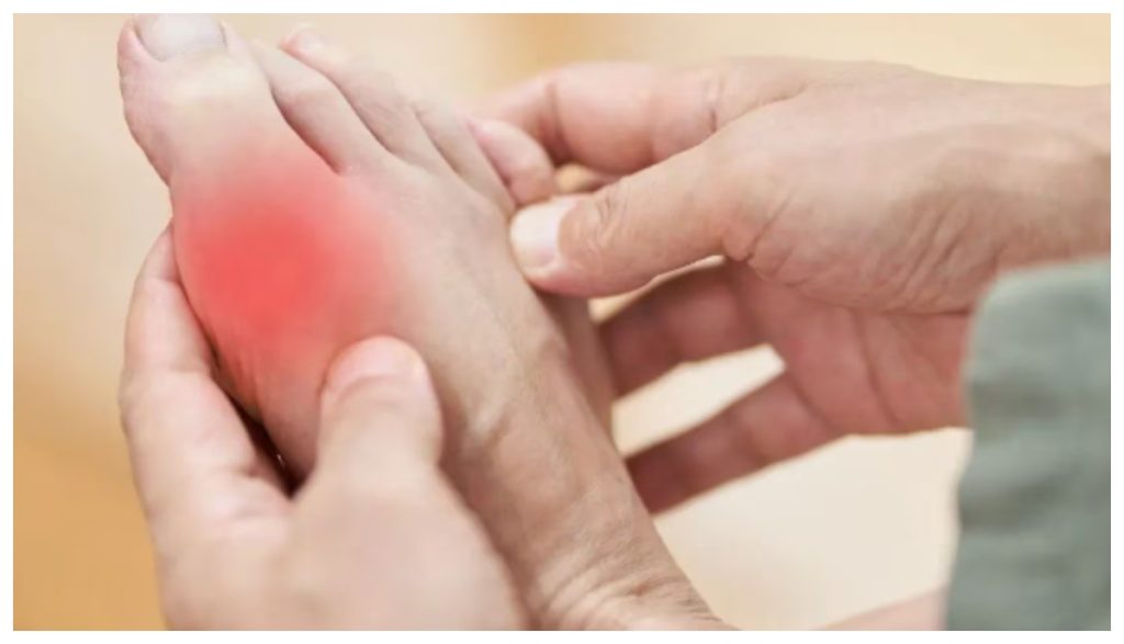 High Uric Acid Has Uric Acid increased? So follow these 5 home tips