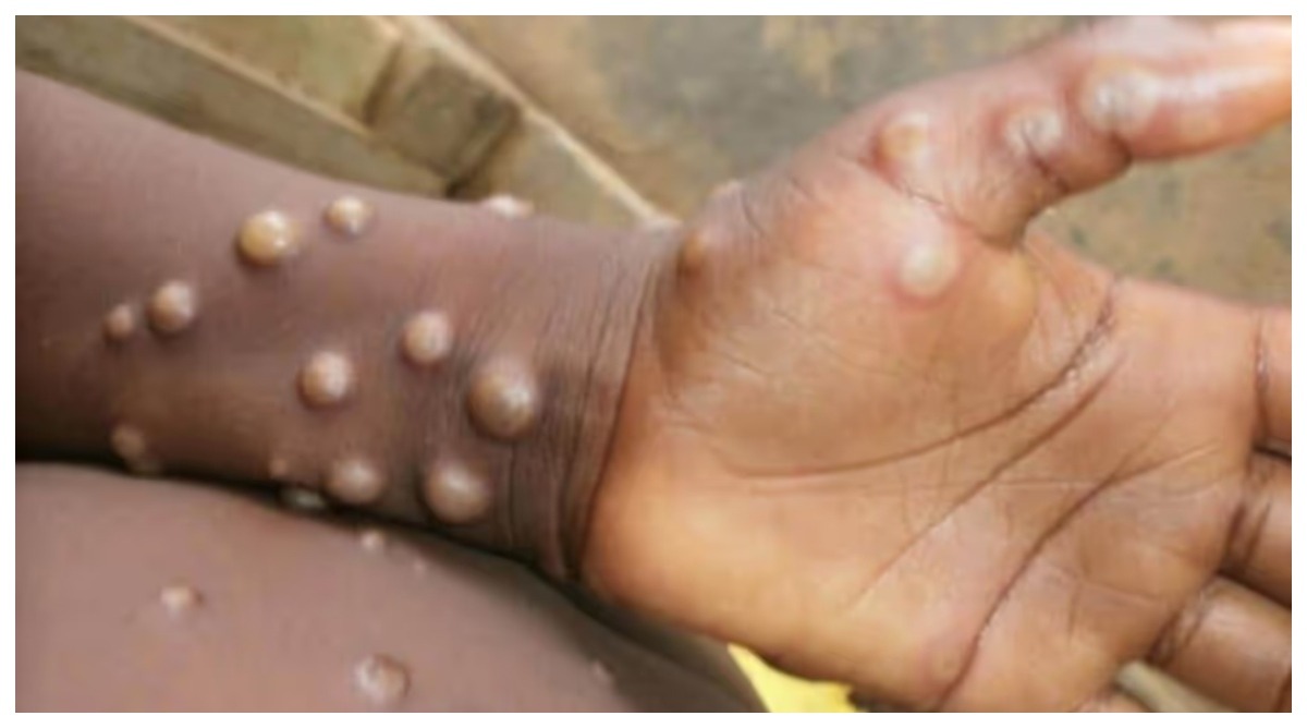 Photo of Monkeypox virus: दुनिया भर में तेजी से फैल रहा मंकीपॉक्स, जानिए क्या है इसके लक्षण?, कैसे करें इससे बचाव