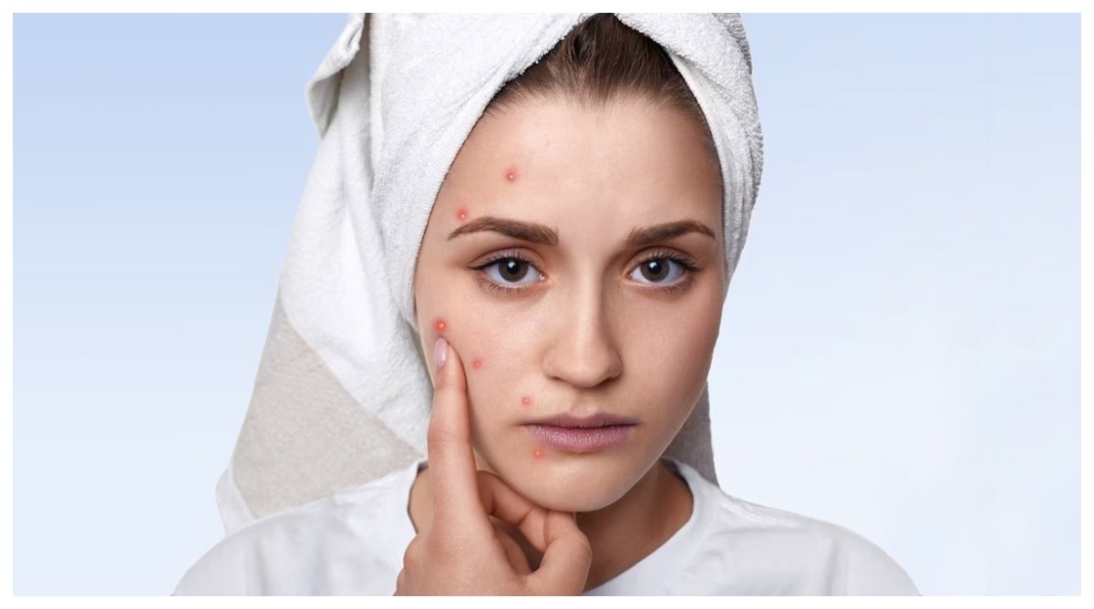 Photo of Skin Care Tips: मानसून के दौरान क्यों होते हैं पिंपल्स? इससे बचाव के लिए अपनाएं ये टिप्स
