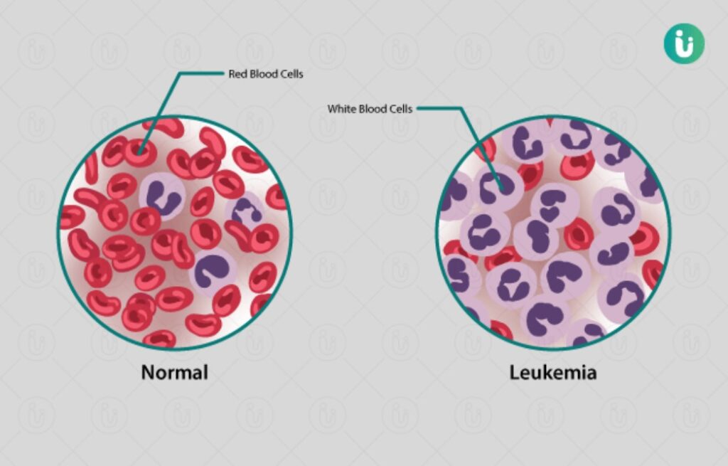 Leukaemia