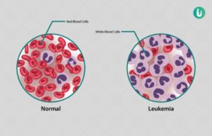 Leukaemia
