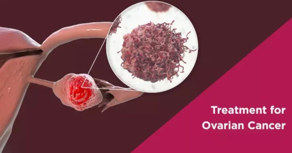 Ovarian Cancer