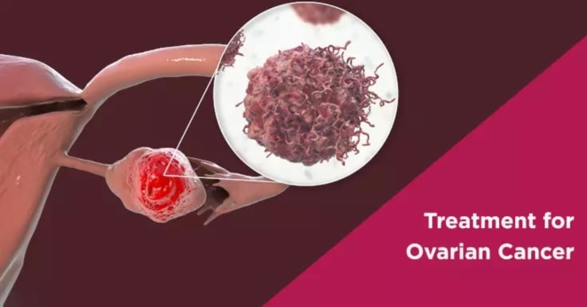 Photo of Ovarian Cancer : गंभीर और चुनौतीपूर्ण बीमारी अंडाशय का कैंसर, जानें क्या है उपचार ?
