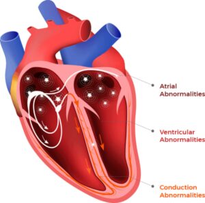 Arrhythmias