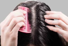 Photo of ठंडी में डैंड्रफ की समस्या क्यों बढ़ जाती है? जानें कारण, इलाज और बचाव के टिप्स